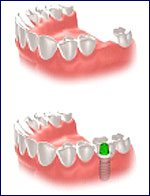 Kroatien Zahnimplantat