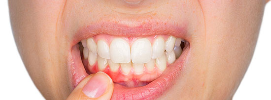 Parodontose, Zahnfleischr�ckgang , Zahnfleischbluten